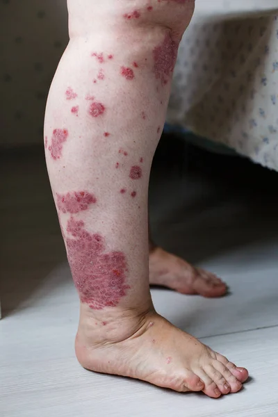 Gros plan éruption cutanée allergique, eczéma cutané du patient, dermatite atopique symptôme texture détail de la peau, champignon de la peau, Le concept dermatologie, traitement. Taches rouges sur la peau du psoriasis. Pieds d'une femme — Photo