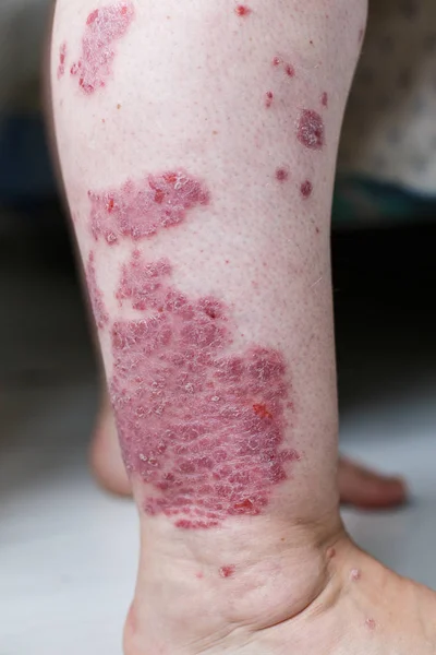 Közelről a beteg allergiás kiütések, ekcéma bőr beteg, atópiás dermatitis tünet bőr hozzárendelésére textúra, gomba, a bőr, a koncepció bőrgyógyászat, a kezelés. Piros foltok a bőr psoriasis. Lábát egy nő — Stock Fotó