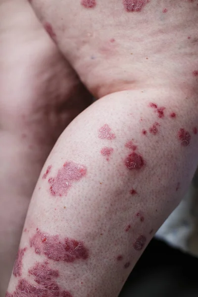 Stäng upp sjuk allergiska utslag, eksem hud av patienten, atopisk dermatit symptom detalj hudstruktur, svamp i huden, konceptet dermatologi, behandling. Röda prickar på psoriasis hud. Fötter av en kvinna — Stockfoto