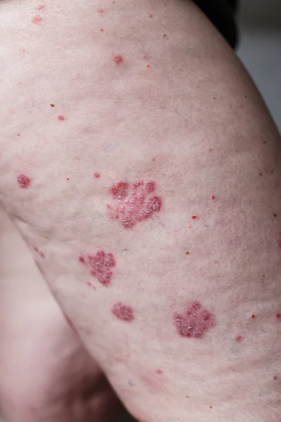 Tutup sakit ruam alergi, kulit eksim pasien, gejala dermatitis atopik tekstur detail kulit, jamur kulit, konsep dermatologi, pengobatan. Bintik merah pada kulit psoriasis. Kaki seorang wanita. — Stok Foto