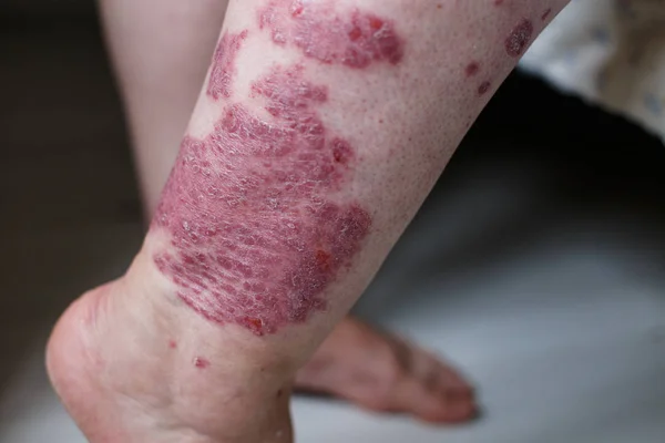 Zblízka špatně alergická vyrážka, ekzém kůže pacienta, atopická dermatitida příznak kůže detail textury, plísně kůže, koncept dermatologie, léčba. Červené skvrny na kůži lupénky. Nohou ženy — Stock fotografie