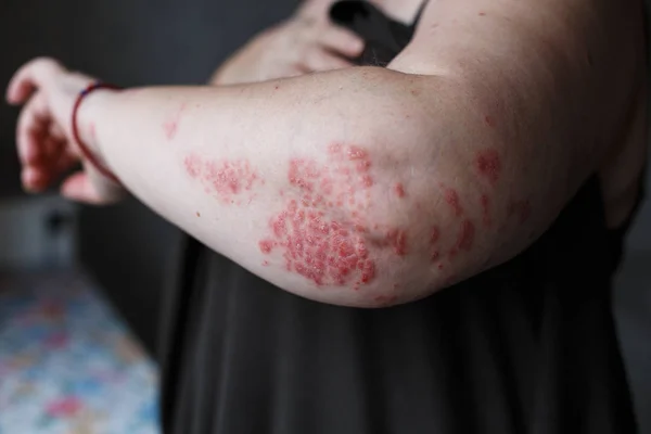 Psoriasis vulgar en las manos de las mujeres con placa, erupción cutánea y manchas en la piel. Enfermedad genética autoinmune. concepto de salud — Foto de Stock