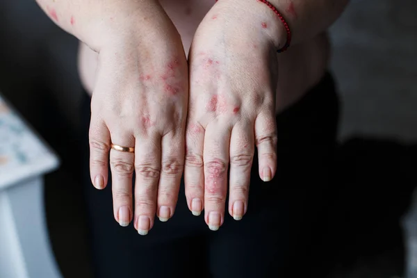 Psoriasis vulgaris on the womans hands with plaque, rash and patches on skin. Autoimmune genetic disease. health concept — Stock Photo, Image