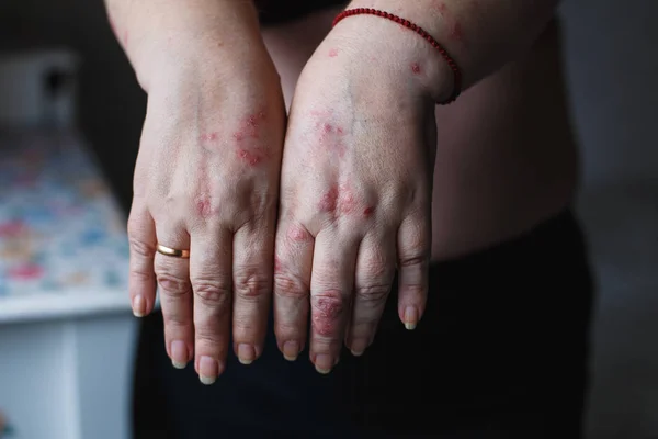 Psoriasis vulgaris sur les mains des femmes avec plaque, éruption cutanée et taches sur la peau. Maladie génétique auto-immune. concept de santé — Photo