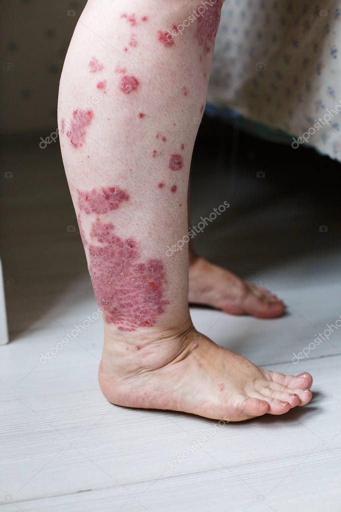 Primer plano erupción alérgica enferma, eczema piel del paciente