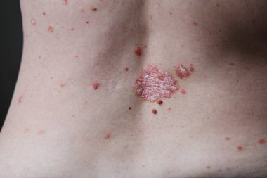 Egzama Atopik dermatit belirti cilt dokusunu. Deri kırmızı lekeler ile kapatmak