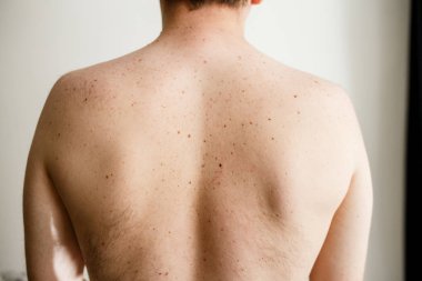 Bir adam geri dağınık benler ve çiller, gövde, Çek iyi huylu benler, cilt üzerinde güneş etkisi bozuklukları çıplak deri detayını kapatın. Doğum lekeleri cilt üzerinde