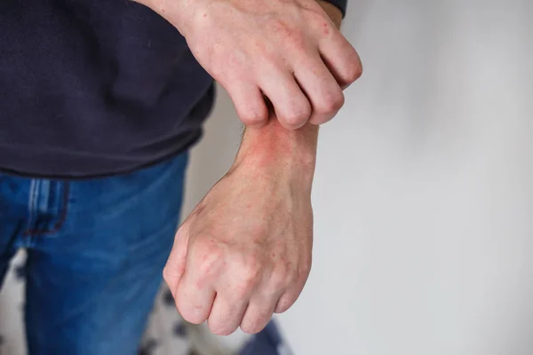 Fechar os homens coçando e coçando à mão. Psoríase ou eczema na mão. Pele alérgica atópica com manchas vermelhas — Fotografia de Stock