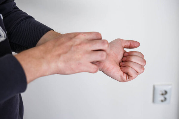 Крупным планом люди чесались и чесались от руки. Псориаз или экзема на руке. Аллергия на атопию