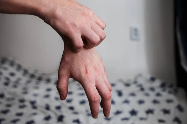 Fechar os homens coçando e coçando à mão. Psoríase ou eczema na mão. Pele alérgica atópica com manchas vermelhas — Fotografia de Stock