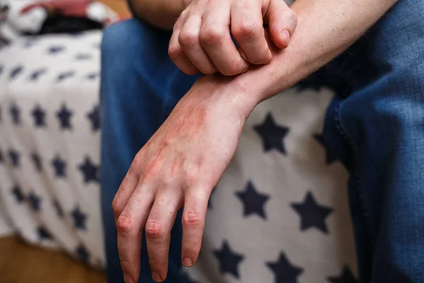 Menutup pria gatal dan menggaruk dengan tangan. Psoriasis atau eksim di tangan. Kulit alergi topik dengan bintik merah — Stok Foto