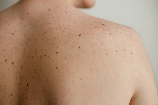 Bliska szczegółów gołej skóry na człowieka z powrotem rozproszone Krety i piegi, zaburzenia ciała, sprawdzanie łagodne moli, wpływ słońca na skórę. Znamiona na skórze — Zdjęcie stockowe