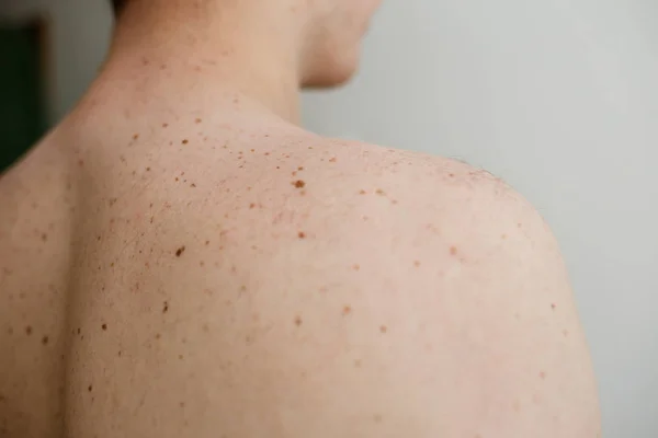 Close up detail of the bare skin on a man back with scattered moles and freckles , Disorders of body , Checking benign moles , Sun effect on skin.