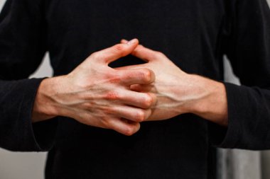 Adam kaşı kendini kuru lapa lapa cilt yandan psoriasis vulgaris, egzama ve mantar, plak, döküntü ve düzeltme ekleri gibi diğer cilt koşulları ile. Otoimmün hastalığı genetik.