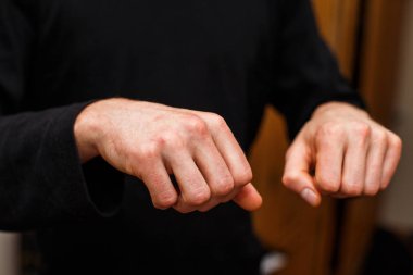 Egzama yandan birçok kişi ile-sorun. Adam siyah itchind Skin.