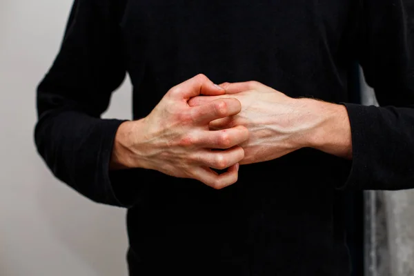 Man scratch oneself, dry flaky skin on hand with psoriasis vulgaris, eczema and other skin conditions like fungus, plaque, rash and patches. Autoimmune genetic disease. — Stock Photo, Image