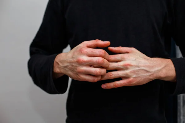 Man scratch oneself, dry flaky skin on hand with psoriasis vulgaris, eczema and other skin conditions like fungus, plaque, rash and patches. Autoimmune genetic disease. — Stock Photo, Image