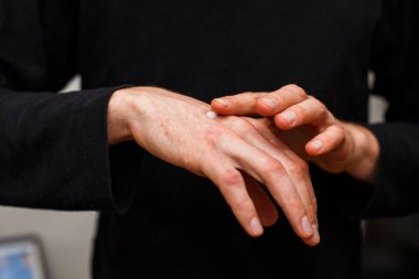 Sıfırdan Allerjik cilt Egzama veya sedef ve steroid ilaç krem, sağlık ve tıp concpet uygulayın. Kırmızı deri tedavi