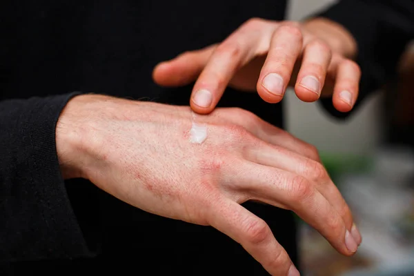 Arranhe a pele alérgica do eczema ou da psoríase e aplique o creme de medicina de esteroides, saúde e medicina concpet. Tratamento na pele vermelha — Fotografia de Stock