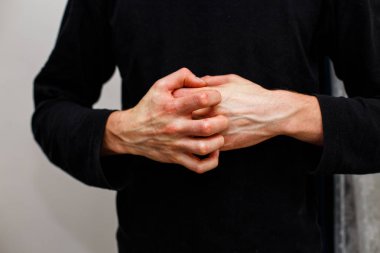 Adam kaşı kendini kuru lapa lapa cilt yandan psoriasis vulgaris, egzama ve mantar, plak, döküntü ve düzeltme ekleri gibi diğer cilt koşulları ile. Otoimmün hastalığı genetik.