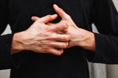 Adam kaşı kendini kuru lapa lapa cilt yandan psoriasis vulgaris, egzama ve mantar, plak, döküntü ve düzeltme ekleri gibi diğer cilt koşulları ile. Otoimmün hastalığı genetik.