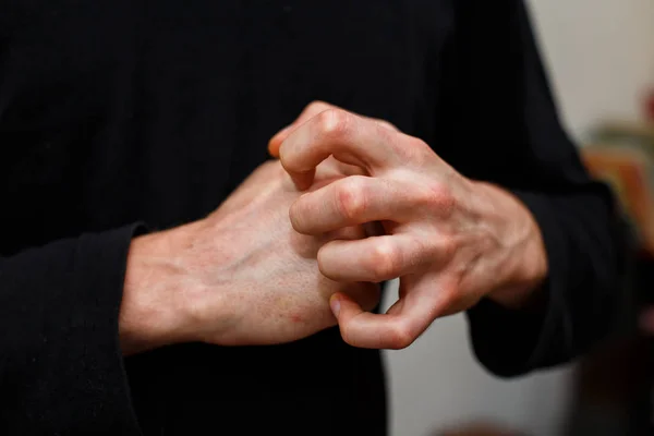 Psoriatic nail disease and skin plaques on hands of a patient with psoriasis. It is an autoimmune disease that affects the skin cause skin inflammation red and scaly. — Stock Photo, Image