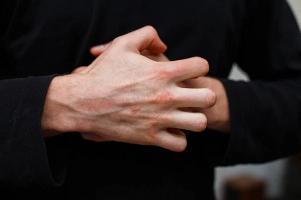 Problém s mnoha lidmi - ekzém na rukou. Černé pozadí. Muž itchind kůže. Psoriasis vulgaris — Stock fotografie