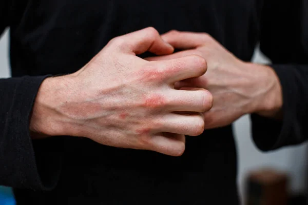 O problema com muitas pessoas - eczema na mão. Fundo preto. Homem comichão na pele. Psoríase vulgar — Fotografia de Stock