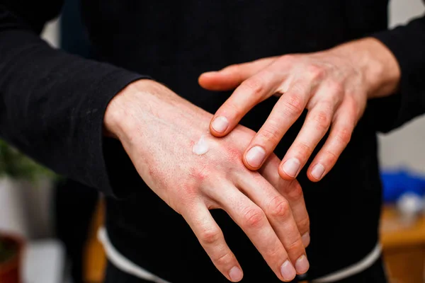 Aplicando um emoliente à pele seca escamosa como no tratamento da psoríase, eczema e outras condições de pele seca. Conceito de saúde — Fotografia de Stock