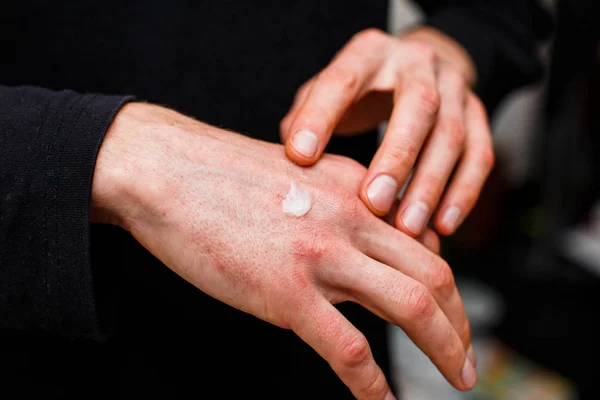 sedef, egzama ve diğer kuru cilt hastalıkları tedavisinde olduğu gibi lapa lapa cilt kurumasını bir yumuşatıcı uygulanıyor. Sağlık kavramı