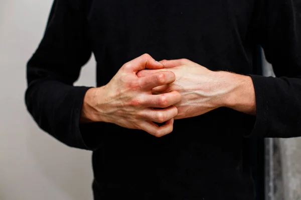 Man kratzt sich, trockene schuppige Haut an der Hand mit Psoriasis vulgaris, Ekzemen und anderen Hauterkrankungen wie Pilz, Plaque, Hautausschlag und Flecken. Autoimmunerkrankung. — Stockfoto