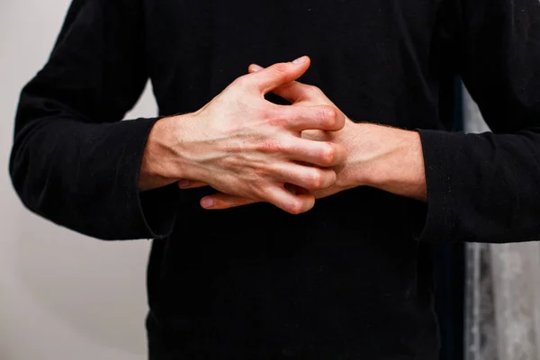 Man scratch oneself, dry flaky skin on hand with psoriasis vulgaris, eczema and other skin conditions like fungus, plaque, rash and patches. Autoimmune genetic disease. — Stock Photo, Image