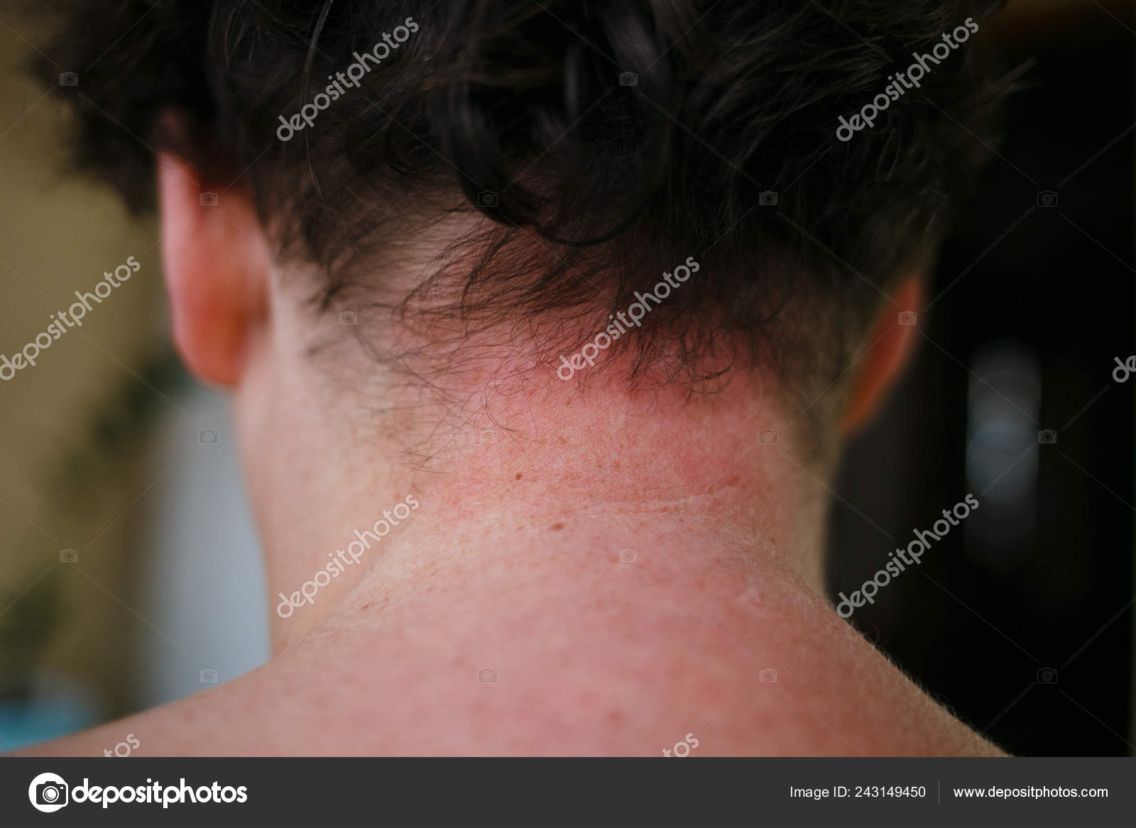 Skin Allergy Symptoms Of Patient Allergic Skin Reaction On The Female Neck And Chest Health Problem Psoriasis Skin Stock Photo By C Ternavskaia O Gmail Com 243149450