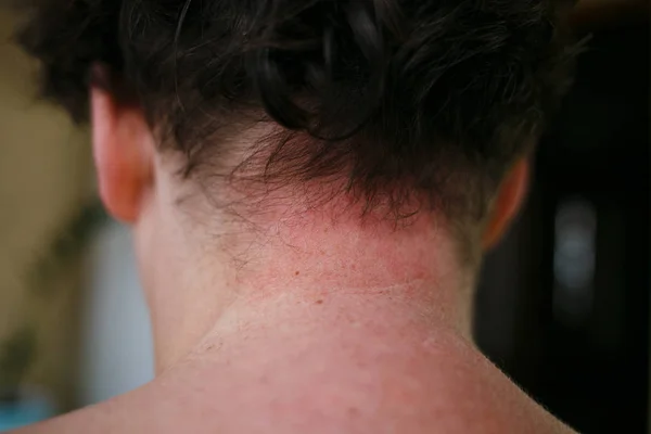 Аллергия на кожу Симптомы пациента, аллергическая реакция кожи на женскую шею и грудь. Проблемы со здоровьем Псориаз кожи — стоковое фото