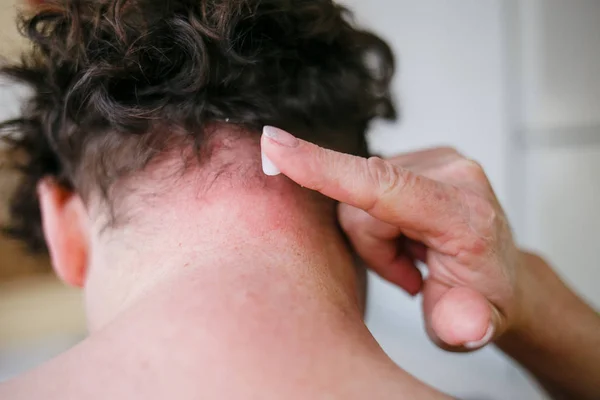 As mãos da mulher lubrificam a pele danificada no pescoço curando a pomada. Tratamento da pele da psoríase. Conceito alérgico . — Fotografia de Stock