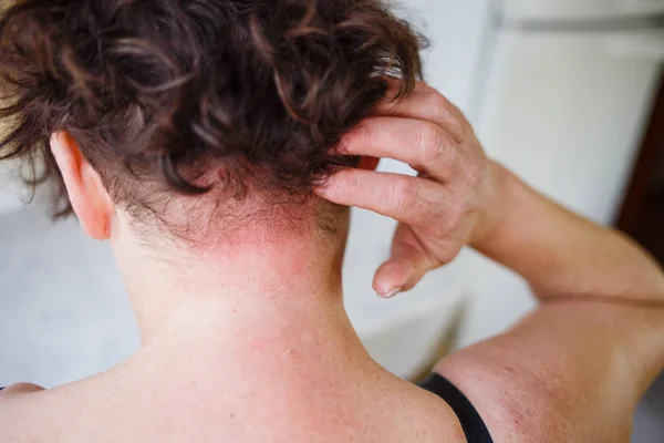 Close up view of woman scratching her neck. Allergy skin — Stock Photo, Image