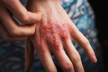 Man scratch oneself, dry flaky skin on hand with psoriasis vulgaris, eczema and other skin conditions like fungus, plaque, rash and patches. Autoimmune genetic disease. clipart