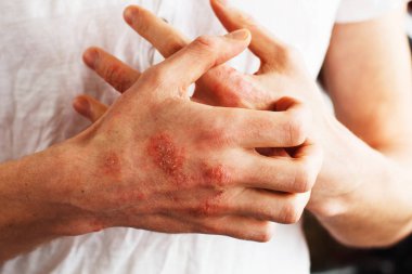 Man scratch oneself, dry flaky skin on hand with psoriasis vulgaris, eczema and other skin conditions like fungus, plaque, rash and patches. Autoimmune genetic disease. clipart