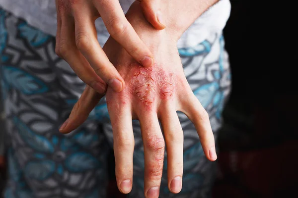 El hombre se rasca a sí mismo, la piel seca escamosa en la mano con psoriasis vulgar, eczema y otras condiciones de la piel como hongos, placa, erupción cutánea y parches. Enfermedad genética autoinmune . —  Fotos de Stock