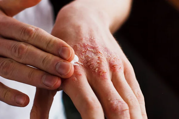 Eczema nas mãos. O homem que aplica a pomada, cremes no tratamento de eczema, psoríase e outras doenças de pele. Conceito de problema cutâneo — Fotografia de Stock