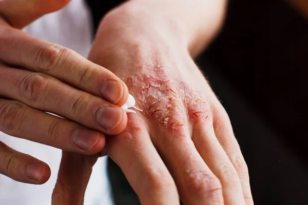 Eccema en las manos. El hombre que aplica el ungüento, cremas en el tratamiento de eczema, psoriasis y otras enfermedades de la piel. Concepto de problema cutáneo — Foto de Stock