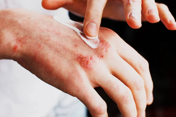 Eczema on the hands. The man applying the ointment , creams in the treatment of eczema, psoriasis and other skin diseases. Skin problem concept — Stock Photo, Image