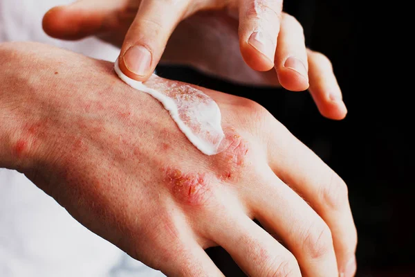 Eczema nas mãos. O homem que aplica a pomada, cremes no tratamento de eczema, psoríase e outras doenças de pele. Conceito de problema cutâneo — Fotografia de Stock