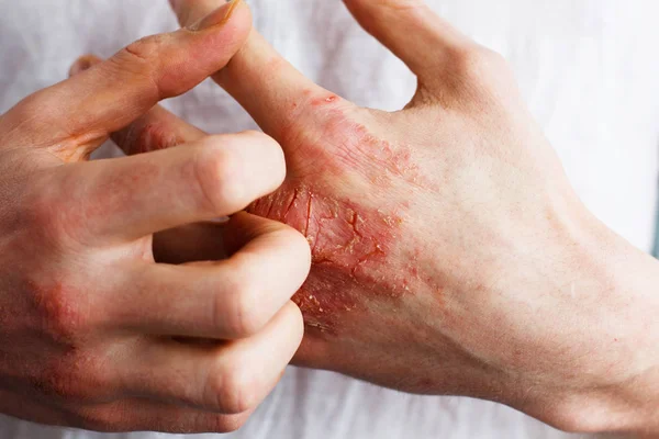 El hombre se rasca a sí mismo, la piel seca escamosa en la mano con psoriasis vulgar, eczema y otras condiciones de la piel como hongos, placa, erupción cutánea y parches. Enfermedad genética autoinmune . — Foto de Stock
