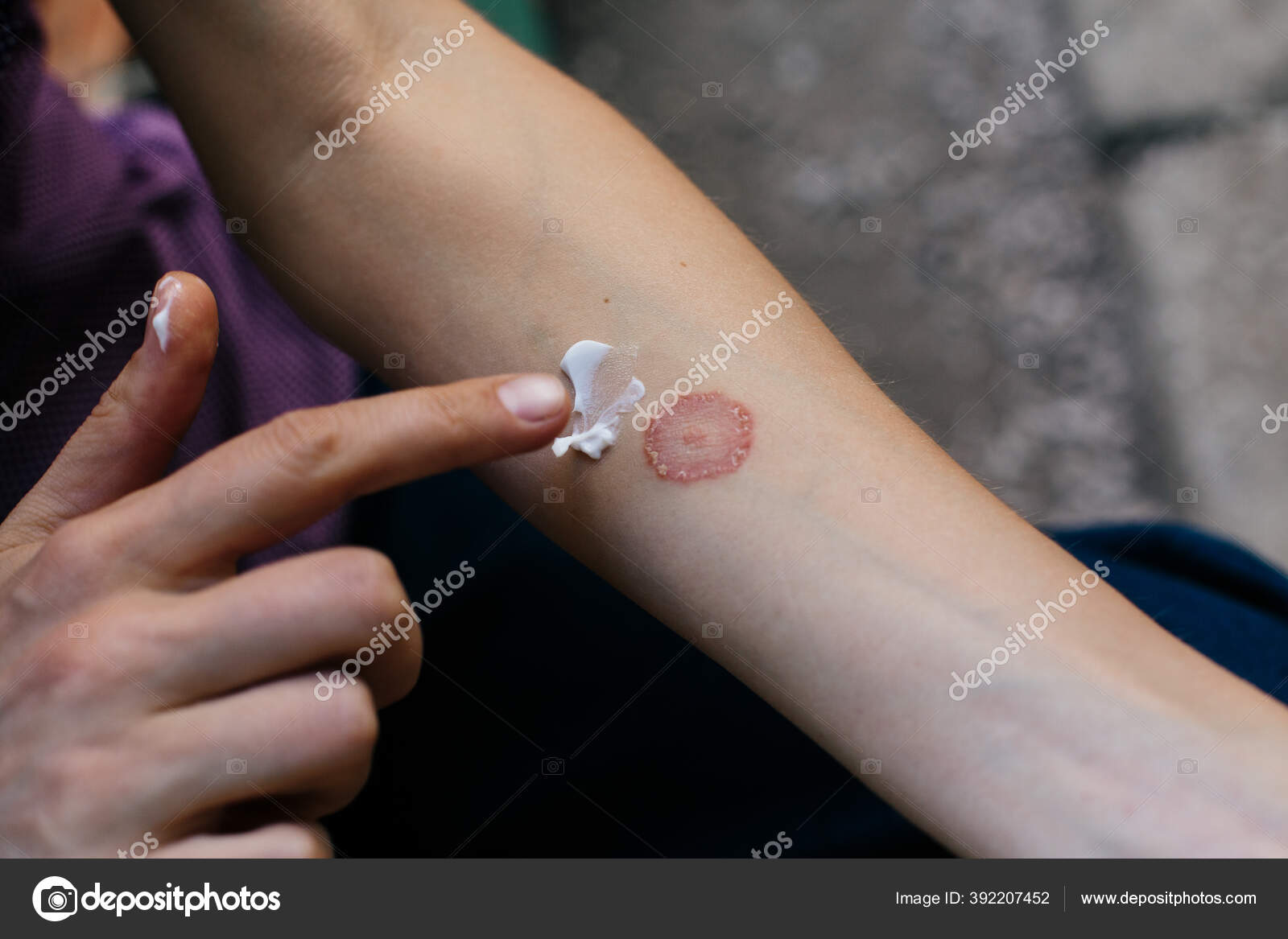 Dermatomycose Images Libres De Droit Photos De Dermatomycose Depositphotos