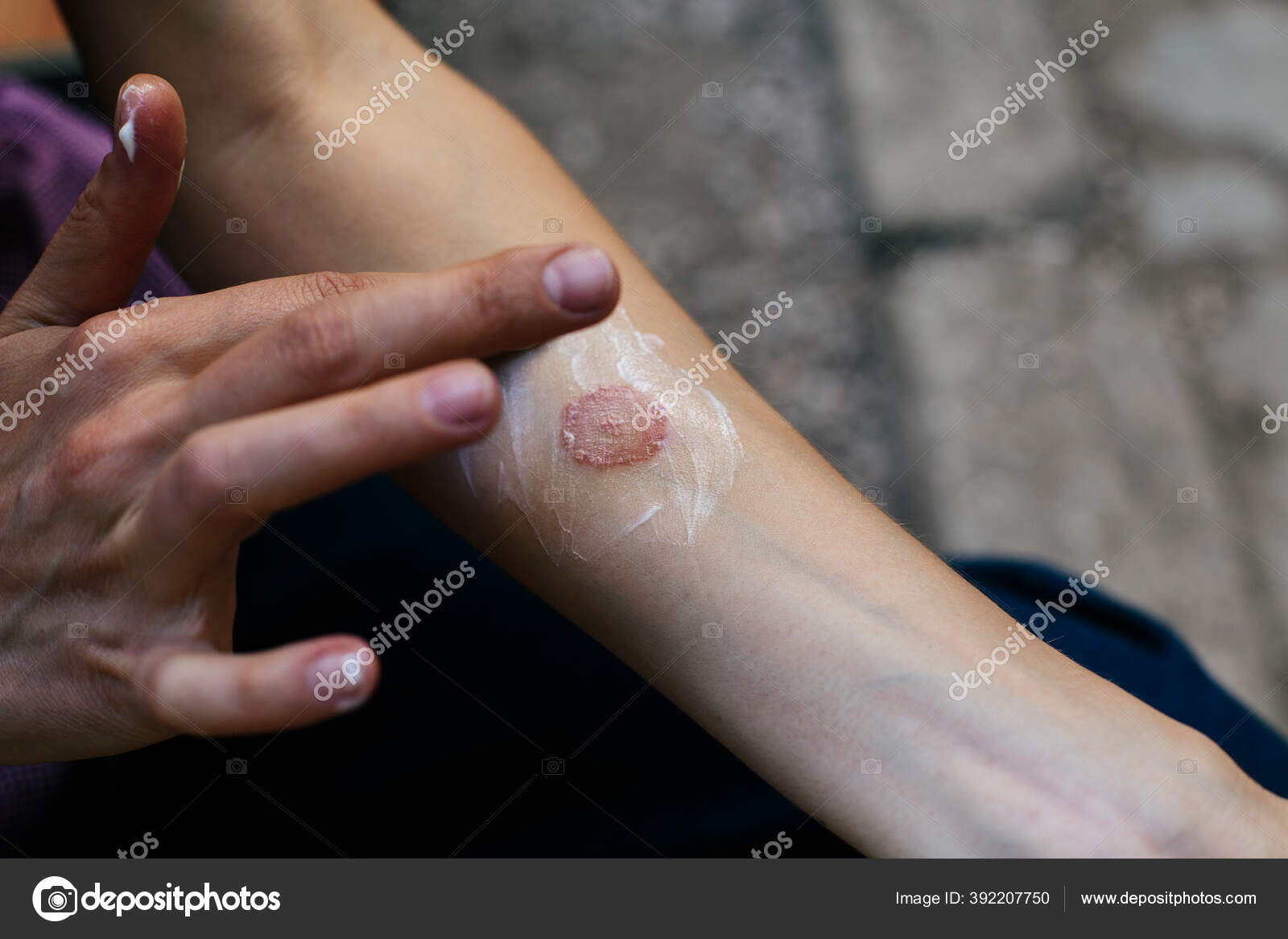 Infecção por vermes anelares, dermatofitose na pele. Aplicar um emoliente  na pele seca escamosa — Foto © ternavskaia.o@gmail.com #392207750, image size:1600x1167