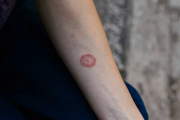 Yüzük solucanı enfeksiyonu, deride dermatofizoz. Kurumuş pullu cilde embriyo uygulanıyor