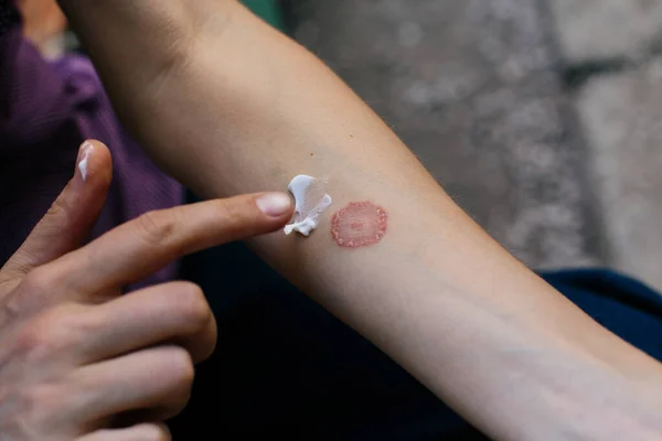 Infección por Gusano Anillo, Dermatofitosis en la piel. Aplicar un emoliente a la piel escamosa seca — Foto de Stock