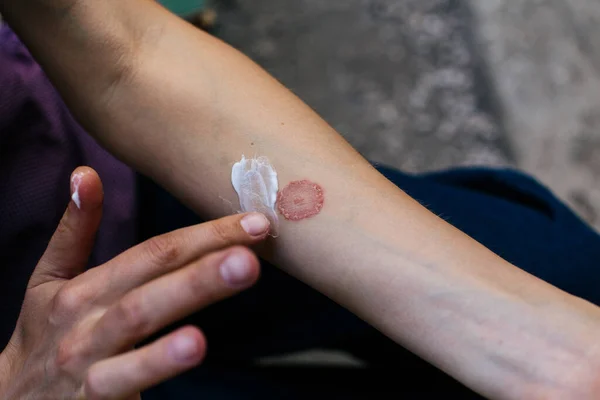 Infecção por vermes anelares, dermatofitose na pele. Aplicar um emoliente na pele seca escamosa — Fotografia de Stock