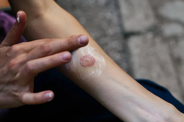 Ring Worm infection, Dermatophytosis on skin. Applying an emollient to dry flaky skin — Stock Photo, Image